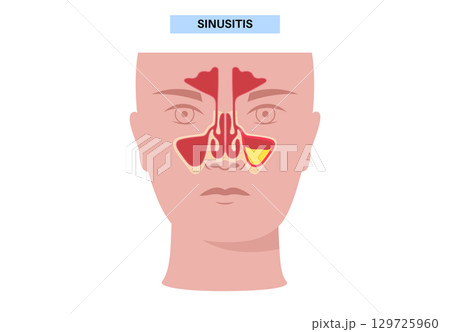 Sinusitis medical poster 129725960