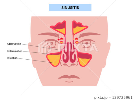 Sinusitis medical poster 129725961