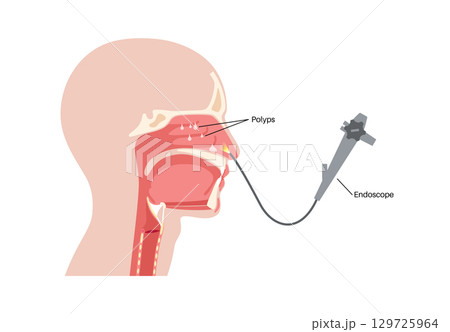 Nasal endoscopy poster 129725964