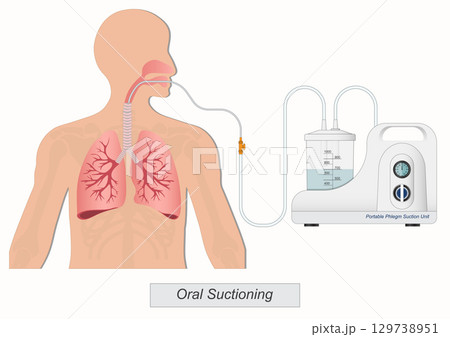Oral suction is suction that is applied to removing mucous secretions. 129738951