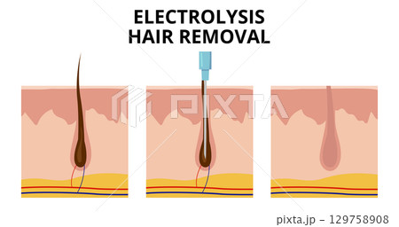 Electrolysis hair removal process showing probe inserting into hair follicle Electrolysis hair removal process showing probe inserting into hair follicle 129758908