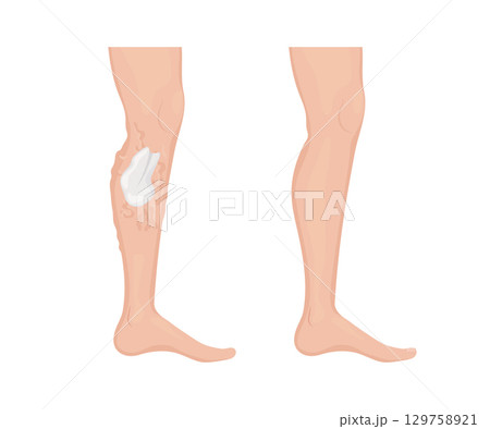 Applying varicose veins treatment cream showing before and after result 129758921