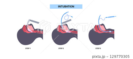 Intubation medical procedure Intubation medical procedure 129770305