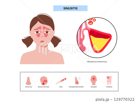 Sinusitis medical poster Sinusitis medical poster 129770322