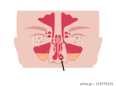 Nasal endoscopy poster Nasal endoscopy poster 129770325