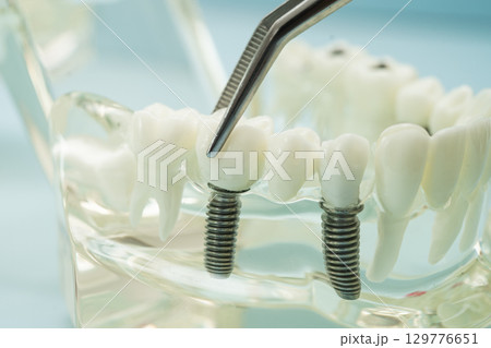 Dental teeth model with dentist tool for dentistry. Dental teeth model with dentist tool for dentistry. 129776651