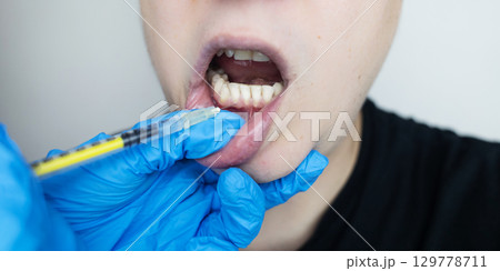 Dental injection for gum recession treatment. Exposure of tooth root and gum treatment. Regenerative therapy Dental injection for gum recession treatment. Exposure of tooth root and gum treatment. Regenerative therapy 129778711
