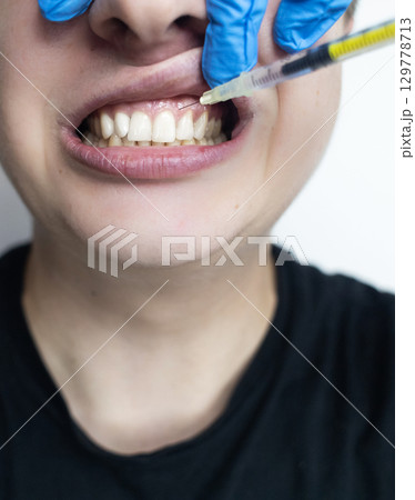 Dental injection for gum recession treatment. Exposure of tooth root and gum treatment. Regenerative therapy Dental injection for gum recession treatment. Exposure of tooth root and gum treatment. Regenerative therapy 129778713
