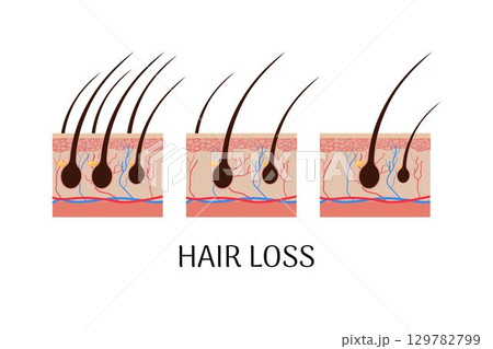 Anatomical concept hair loss stages 129782799