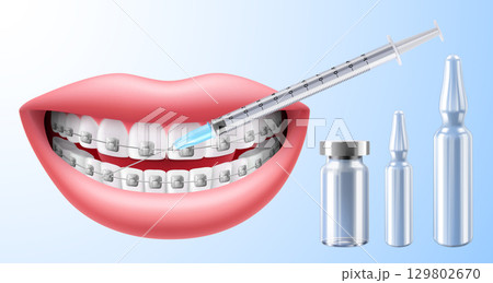 Female lips and injection syringe with Bottle for injection, Drug Ampoule, glass vial. lips augmentation procedure with hyaluronic acid, botox or filler. Realistic 3d vector illustration Female lips and injection syringe with Bottle for injection, Drug Ampoule, glass vial. lips augmentation procedure with hyaluronic acid, botox or filler. Realistic 3d vector illustration 129802670