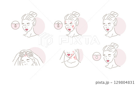 Beauty Girl Have Acne on her Face, Neck and Hair Skin. Blackheads, Whiteheads, Post Acne and other Acne Skin Problems Beauty Girl Have Acne on her Face, Neck and Hair Skin. Blackheads, Whiteheads, Post Acne and other Acne Skin Problems 129804831