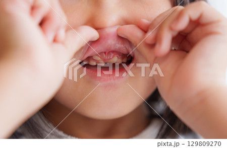 乳歯が抜けないのに永久歯が生えてきた子供 129809270