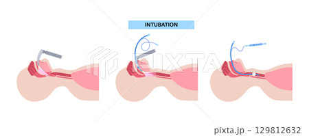 Intubation medical procedure Intubation medical procedure 129812632