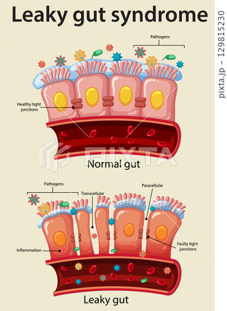 Comparison of Normal Gut and Leaky Gut Syndrome Comparison of Normal Gut and Leaky Gut Syndrome 129815230
