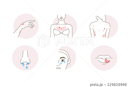 Beauty Girl Have Acne on her Face, Neck and Hair Skin. Blackheads, Whiteheads, Post Acne and other Acne Skin Problems 129828998
