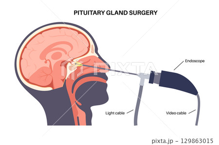Pituitary gland surgery 129863015