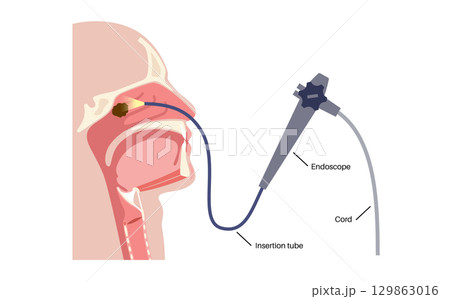Nasal tumor surgery 129863016