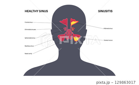 Sinusitis medical poster 129863017