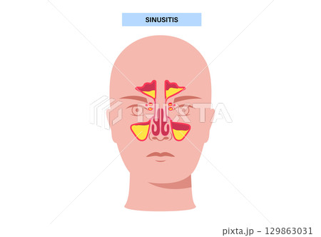 Sinusitis medical poster 129863031