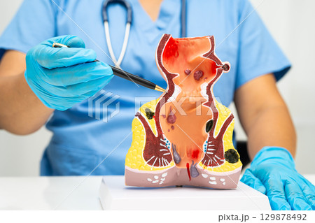 Asian doctor with rectum and hemorrhoid human anatomy model at hospital, inflamed vascular structure. Asian doctor with rectum and hemorrhoid human anatomy model at hospital, inflamed vascular structure. 129878492
