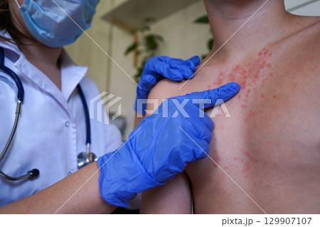 A doctor in blue gloves examines the rash on the boy's body. 129907107