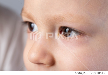 Pus in a little boy's eyes. Concept of bacterial and viral conjunctivitis in children, close-up 129910517