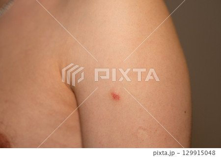 Red, itchy patches on the arm exhibit symptoms commonly associated with psoriasis Red, itchy patches on the arm exhibit symptoms commonly associated with psoriasis 129915048