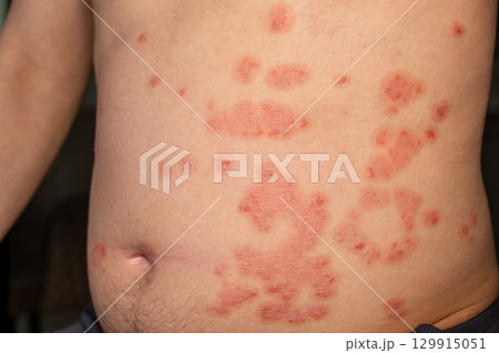 Red itchy patches on skin caused by psoriasis highlighting a common autoimmune skin condition 129915051