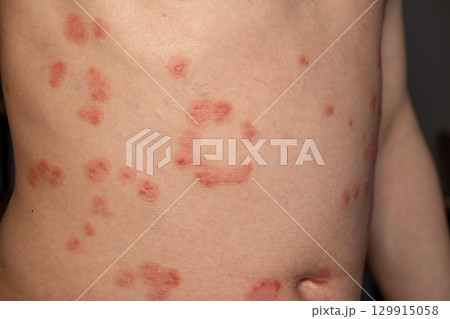 Skin patches reveal the symptoms of psoriasis on an individuals abdomen, demonstrating the effects of a chronic skin condition 129915058