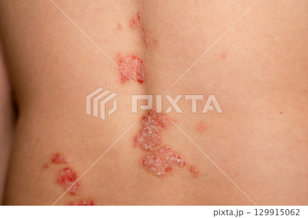 Psoriasis skin patches on a persons back showing red, itchy, and scaly spots indicative of this genetic immune disease Psoriasis skin patches on a persons back showing red, itchy, and scaly spots indicative of this genetic immune disease 129915062