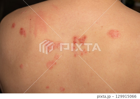 Skin patches affected by psoriasis display red, itchy, and scaly texture on the back of an individual in a clinical setting 129915066