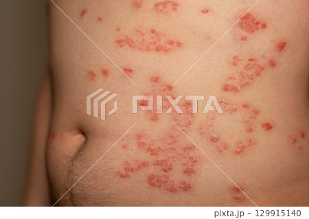 Red scaly patches on skin indicating psoriasis condition affecting the abdomen of an individual 129915140