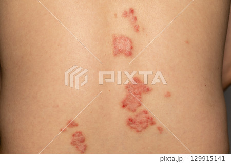 Psoriasis patches on skin highlighting symptoms of a chronic immune disease 129915141