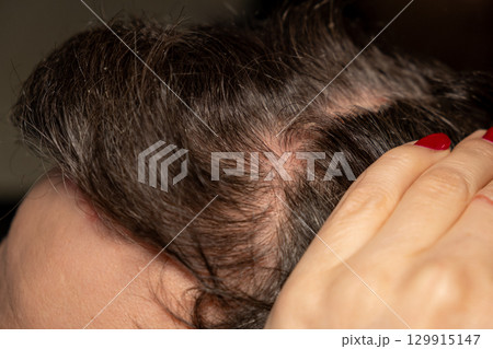 Scalp psoriasis characterized by red patches and scaly skin highlighting a common genetic immune condition 129915147