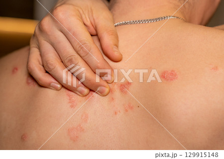 Psoriasis manifests as itchy, scaly patches on the skin, affecting individuals with this genetic immune disease Psoriasis manifests as itchy, scaly patches on the skin, affecting individuals with this genetic immune disease 129915148