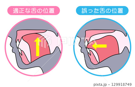 正しいミューイングの方法　適正な舌の位置と誤った舌の位置 129918749