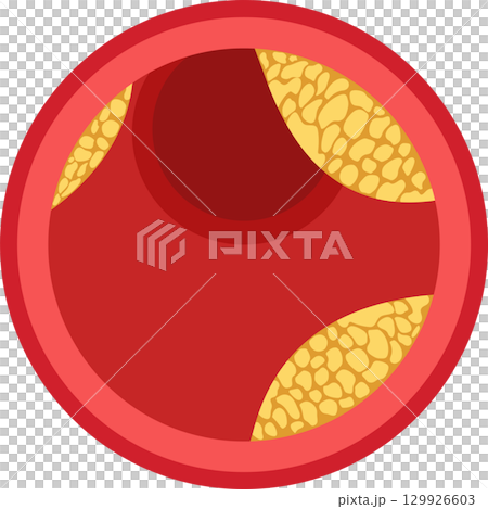 Illustration showing a blood vessel with plaque buildup, a visual representation of atherosclerosis. 129926603