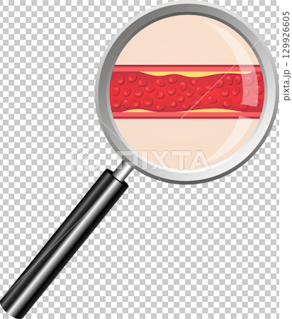 Magnified View: Arterial blockage, showing blood cells and plaque buildup in vessel walls. 129926605