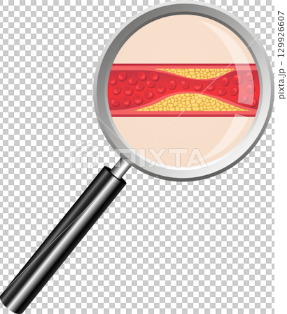 Magnified Artery: Atherosclerosis close-up showing plaque buildup and reduced blood flow. 129926607