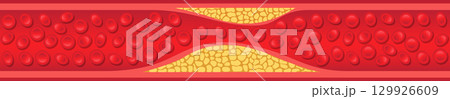 Blood vessel with plaque buildup, a health issue that can lead to cardiovascular problems. Blood vessel with plaque buildup, a health issue that can lead to cardiovascular problems. 129926609