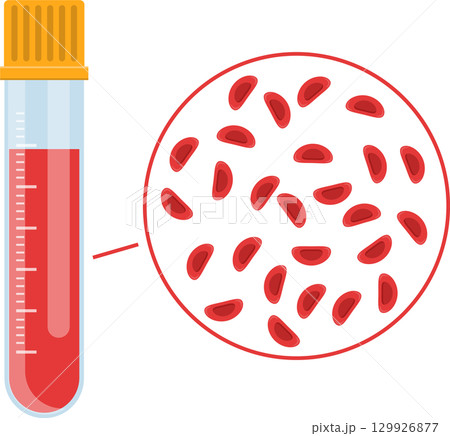 Blood sample in tube with magnified view of red blood cells for medical analysis and diagnosis. Blood sample in tube with magnified view of red blood cells for medical analysis and diagnosis. 129926877