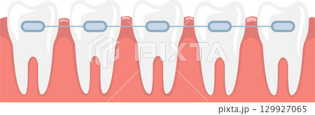 Dental braces on teeth illustration showing the orthodontic treatment for teeth alignment. Dental braces on teeth illustration showing the orthodontic treatment for teeth alignment. 129927065
