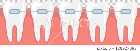 Dental braces on teeth illustration showing the orthodontic treatment for teeth alignment. 129927065