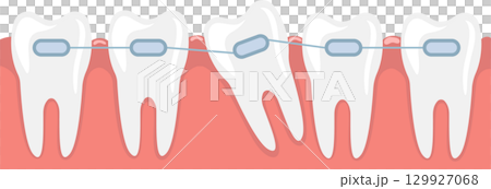 Dental Braces Correcting Malocclusion: A Visual Representation of Orthodontic Treatment 129927068