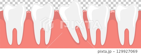 Dental illustration of teeth with one being impacted, causing potential alignment issues. 129927069