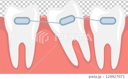 Illustration of teeth with braces, showing an impacted tooth being pulled into correct position. 129927071
