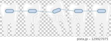 Dental Braces Adjusting Crooked Tooth: Orthodontic treatment straightening teeth with fixed appliance. Dental Braces Adjusting Crooked Tooth: Orthodontic treatment straightening teeth with fixed appliance. 129927075