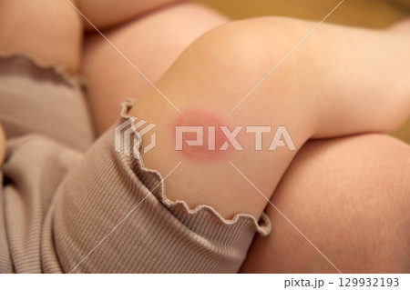 A child is sitting on the floor inside a cozy living room, revealing a pronounced red mosquito bite on their knee 129932193