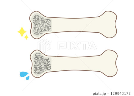 丈夫な骨と脆い骨の骨密度を比較するイラスト 129943172