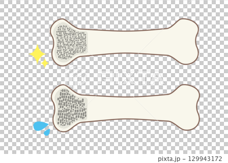丈夫な骨と脆い骨の骨密度を比較するイラスト 129943172